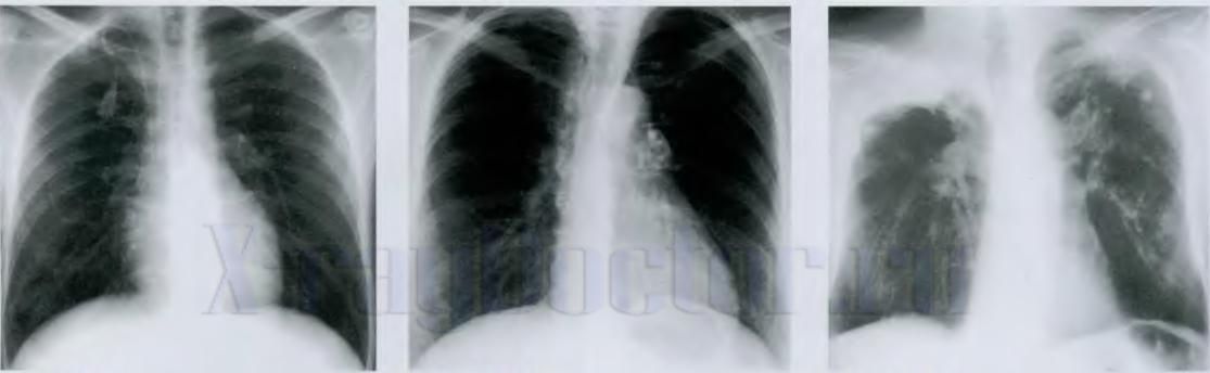 белые пятна на рентгене легких при туберкулезе